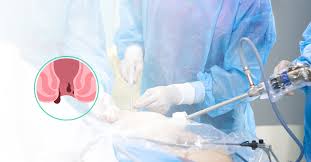 Fistula Surgery Singapore: Complete Treatment Guide & Cost Information